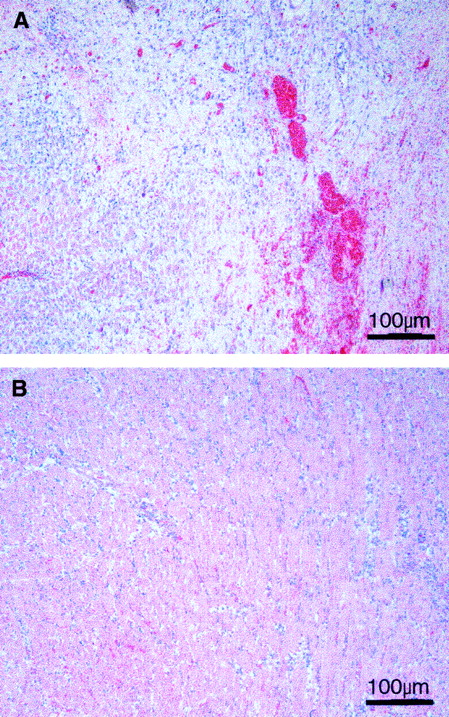 Fig. 7. PNU156804 blocks allograft damage to myocytes and reduces infiltration of polymorphonuclear cells. / BUF heart allografts were harvested and examined on day after grafting from WF recipients that received alternate-day oral gavage of DMSO vehicle alone (A) or vehicle with 80 mg/kg PNU156804 (B). The presented sections were obtained after uniform histologic analysis of 3 hearts for each experimental group, with 12 horizontal cuts made on each heart. Each section was scored using the Society of Heart and Lung Transplantation system. See “Materials and methods” for details. Original magnification, × 200.