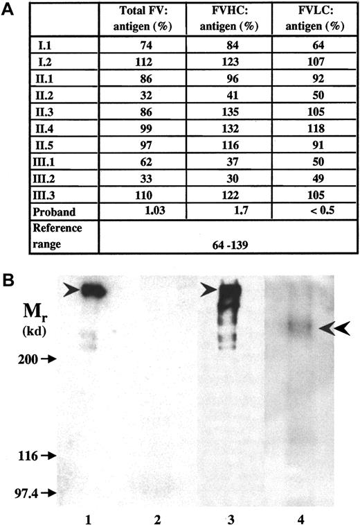 Fig. 2. Factor V antigen in the plasma of the proband and family members. / (A) Measurement of factor V antigen by 3 different sandwich ELISAs. The following capture antibodies were used: a polyclonal anti–factor V antibody (total factor V antigen); a monoclonal antibody against an epitope on factor V B-domain that detects the N-terminal portion of the molecule containing factor V HC plus the connecting region (FVHC antigen); and a monoclonal antibody against an epitope on factor V light chain (FVLC antigen). The reference interval obtained by Montefusco et al12 was used for comparison. (B) The detection of factor V by Western blotting. SDS-PAGE was carried out in 5% gel. The sample loaded onto the gel contained 0.625 μL normal (lane 1) and 12.5 μL patient (lane 2) plasma or factor V immunoprecipated from 2.5 μL normal plasma (lane 3) and 250 μL patient's (lane 4) plasma. Biotinylated polyclonal antibody against factor V and Vectastain ABC kit were used for the detection of factor V in plasma samples (lanes 1,2), while the blots of immunoprecipitates (lanes 3,4) were developed by monoclonal anti–factor V B-domain antibody and peroxidase-labeled antimouse IgG. Arrows indicate the position of Mr marker proteins; arrowheads point to intact factor V molecule; and double arrowhead points to the faint band representing truncated factor V present in the patient's sample. In the immunoprecipitate from normal control plasma, some breakdown product of factor V could also be seen.