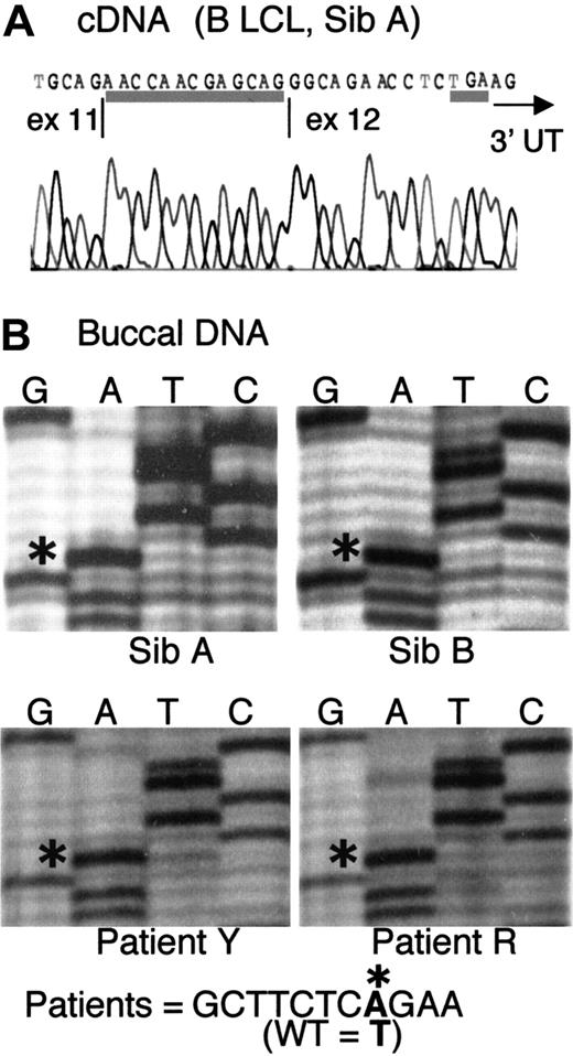 Fig. 1. Cryptic splicing due to a point mutation in IVS 11. / (A) Sequence of ADA cDNA clone derived from B LCL of Sib A, showing a 13-nt insert at the exon 11/12 junction (underlined). The insert corresponds to g.31703-31715, normally the last 13 nt of IVS 11. The TGA stop codon (underlined) and the start of the 3′ untranslated region (3′UTR, arrow) are indicated. (B) Partial sequences of fragment g.31016-31920 (IVS 10-exon 12) amplified from uncloned DNA from buccal brushings of patients, as indicated. The sequence g.31694-31704 is shown. Asterisks indicate an A at nt g.31701 in all 4 patients, instead of T found in wild-type (WT) human ADA.