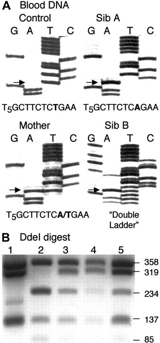 Fig. 2. Analysis of IVS 11 mutations in whole blood DNA. / (A) Sequence of segment g.31689-31704 (IVS 11) in PCR fragment g.31016-31920 (IVS 10-exon 12) from normal control, Sib A, Sib B, and their mother, as indicated. Arrows indicate g.31701. Sib A is homozygous, and her mother is heterozygous, for g.31701T>A. Blood DNA of Sib B gives a “double ladder.” (B) Ethidium bromide–stained agarose gel of a DdeI digest of fragment g.31016-31920 (IVS 10-exon 12) amplified from normal control DNA (lane 1), and from blood DNA of Sib A (lane 2), Sib B (lane 3), and their parents (lane 4, father; lane 5, mother). The 234- and 85-nt products are due to a novelDdeI site introduced by the g.31701T>A mutation.