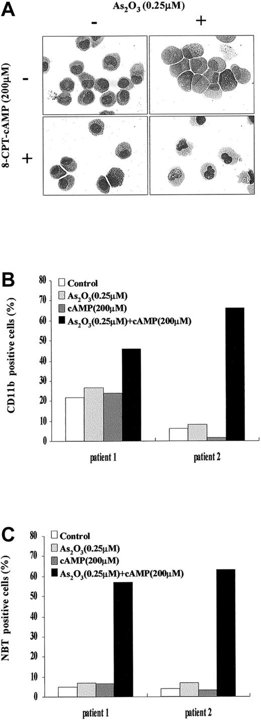 Fig. 2. Effects of As2O3 or cAMP or both on primary leukemia cells from 2 patients with de novo APL. / (A) Morphologic features of primary leukemia cells from patient 1 after 9 days of exposure to the drugs as indicated. Similar morphologic changes were also observed in patient 2. Original magnification × 1000. (B) Expression of CD11b integrin of primary leukemia cells from patient 1 and patient 2 following the indicated treatments. (C) NBT-reducing activity of primary leukemia cells from patient 1 and patient 2 following the indicated treatments.