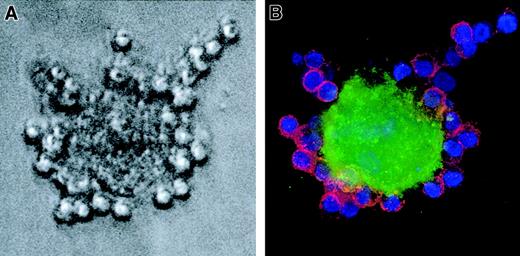 Fig. 1. NLCs express CD14. / Whole blood mononuclear cells from a patient with CLL were cultured for 14 days in a chambered microscope slide. (A) A very large, round NLC is seen surrounded by smaller leukemia B cells by phase contrast microscopy. (B) The same cell is seen by immunofluorescence microscopy to bind FITC-labeled mAbs specific for CD14 (green fluorescence), whereas the small leukemia B cells bind PE-labeled mAb specific for CD19 (red fluorescence). The nuclei of the leukemia B cells have the blue fluorescence of Hoechst 33258. The Hoechst staining of the NLC nucleus is less evident because of the confocal plane in which the photograph was made.