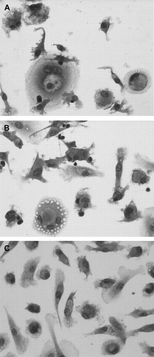 Fig. 7. CD14+ cells differentiate into NLCs in the presence of CLL B cells but not normal B cells. / CD14+ mononuclear cells were isolated from the blood of healthy donors and then cocultured with sorted CD19+ blood mononuclear cells from either patients with CLL (A) or healthy donors (B), or they were cultured alone (C). Fourteen days later, the adherent cells were examined for morphology after May-Giemsa staining.