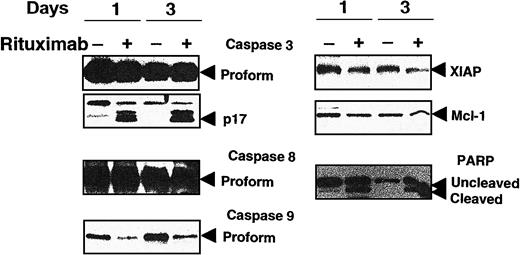 Fig. 1. Representative Western blot study from patient 17 demonstrating findings before and after therapy with rituximab. / CLL cells from the blood were recovered from patients before treatment (−) and on days 1 and 3 of treatment (+). Protein lysates were prepared, normalized for total protein content, and analyzed by SDS-PAGE/immunoblotting using antibodies specific for casepase-3, caspase-8, caspase-9, PARP, Mcl-1, and XIAP. Mcl-1 and XIAP are down-regulated. Caspase-3 was processed with formation of active p17 after treatment with rituximab on days 1 and 3 concurrent with PARP cleavage. Caspase-8 proform level remained unchanged. Caspase-9 proform level was reduced after treatment with rituximab on days 1 and 3, indicating that caspase-9 is being processed.