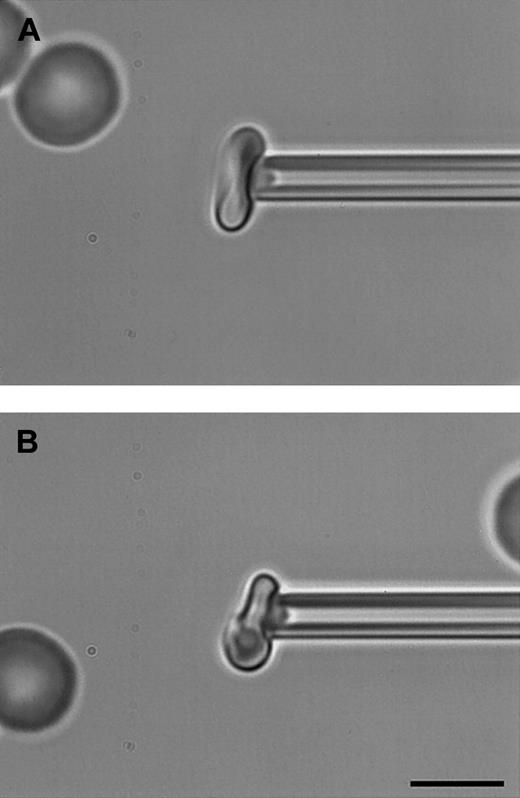 Fig. 1. Determination of membrane shear elastic modulus by micropipette aspiration. / Bright-field digitally captured images of a typical micropipette (1.3 μm internal diameter) used for determination of the shear elastic modulus of (A) an uninfected RBC and (B) an RBC infected with a mature malaria (P falciparum) parasite as described in “Materials and methods.” A portion of the RBC membrane aspirated into the pipette can be visualized clearly, shown here at a pressure of 2.0 mm H2O (A) and 4.0 mm H2O (B). Note that in panel B, only PRBCs that remained approximately discoid and that contained relatively small but mature trophozoites were measured so that there was sufficient free membrane to aspirate away from the parasite itself. Scale bar, 5 μm.