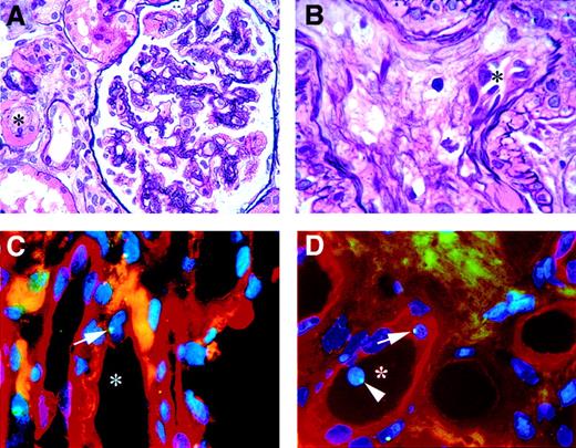 Fig. 1. Kidney biopsy. / Histology (A-B) and immunohistochemistry and FISH (C-D). (A-B) Hematoxylin and eosin silver staining, showing the characteristics of thrombotic microangiopathy. (A) Reduced vascular lumen (*) of arteriole next to a glomerulus with reduced capillary lumina and ischaemic winding of some basement membranes. (B) Renal arteriole with a reduced vascular lumen (*) and mucoid intima degeneration. (C-D) The participation of male donor bone marrow cells in vascular endothelial repair and maintenance in a female kidney. Endothelial cells are stained with Ulex Europaeus TRITC, and the green dots in the blue nuclei (DAPI) are FISH-stained Y chromosomes. (C) Vessel (*) with male endothelial cell (arrow). (D) Vessel (*) with male endothelial cell (arrow) and a circulating male cell (arrowhead). Original magnification A, × 630; B-D, × 1000.
