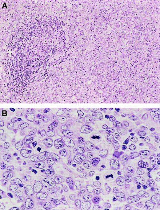 Fig. 2. Histopathologic features of de novo CD5+DLBCL. / (A) Lymphoma cells spare a follicle retaining a lymphocyte cuff. (B) Lymphoma cells are large and show a centroblastic feature.