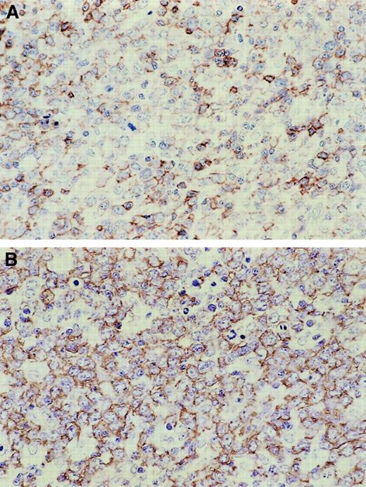 Fig. 3. Immunohistochemical features of de novo CD5+DLBCL. / Lymphoma cells are positive for CD5 (A) and CD20 (B).