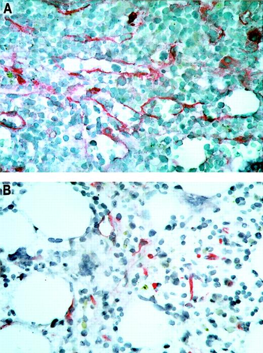 Fig. 3. Immunohistochemical staining of bone marrow sections. / Microvascular endothelial cells were highlighted by antibodies against thrombomodulin. The bone marrow biopsies were taken from patient no. 11 with AML before (panel A) and 1 month after (panel B) treatment with thalidomide. Note the visible reduction in microvessel density of the bone marrow during thalidomide treatment in this patient with a partial response. Original magnification × 500.
