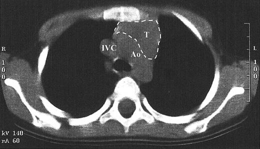 Fig. 6. Computed tomography scan of the anterior mediastinum of a Jak3-deficient SCID patient 4 years after transplantation. / Thymic tissue is indicated by the dashed lines. It is in the normal position and measures 3.8 cm in its greatest transverse dimension, which is normal for age. Ao indicates aortic arch; IVC, inferior vena cava; T, thymus.