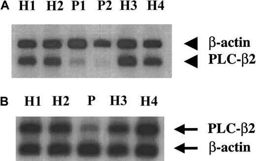 Fig. 2. Platelet PLC-β2 mRNA levels in the patient and healthy subjects. / Platelet RNA from the patient (P) and healthy subjects (H) was subjected to RT-PCR in the presence of 32P-dCTP using 2 sets of PLC-β2 primers (A,B) and β-actin primers, under conditions of linearity of amplification, as described in “Patient, materials, and methods.” The products were subjected to gel electrophoresis, transferred to membrane, and analyzed by phosphorimaging. (A) The PLC-β2 primers used were forward: 2864 nt to 2885 nt; reverse: 3328 nt to 3352 nt. P1 and P2 represent patient samples from 2 separate occasions. (B) The PLC-β2 primers used were forward: 3188 nt to 3212 nt, reverse: 4492 nt to 4516 nt, with the latter being in the 3′ untranslated region (see Figure 1).