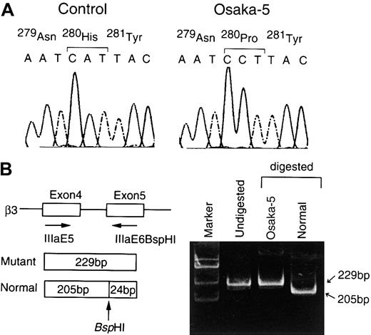 Fig. 2. Analysis of β3 cDNA and theβ3 gene in patient Osaka-5. / (A) Nucleotide sequence analysis of β3 cDNA in patient Osaka-5. The β3 cDNAs from control or Osaka-5 platelets were amplified by RT-PCR. The amplified fragments were directly examined using Taq DyeDeoxy Terminator Cycle Sequencing kit. Samples were run and analyzed on an ABI 373A DNA sequencer. (B) Allele-specific restriction enzyme analysis. The region around exon 5 of the β3 gene was amplified by PCR using primers IIIaE5 and IIIaE6BspHI, followed by digestion with BspHI.BspHI digestion of the PCR products yields 205-bp and 24-bp fragments in normal allele. The A→C substitution abolished a restriction site for BspHI. The resulting fragments were electrophoresed in a 6% polyacrylamide gel; φX174 digested withHaeIII was used as a marker.