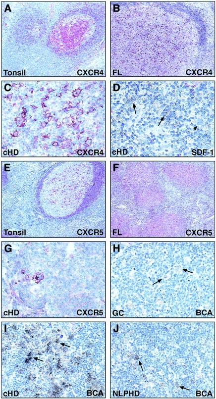 Fig. 5. Immunohistology of CXCR4 and CXCR5. / Immunohistochemical detection on paraffin-embedded sections using the 2B11/CXCR4 (A-C) and 8B2/CXCR5 (E-G) monoclonal antibodies. Most follicular mantle cells and some germinal center cells express CXCR4 in a hyperplastic tonsil (A). The neoplastic cells of some follicular lymphomas (B) and a case of cHD (C) are strongly CXCR4 positive. (D) In situ hybridization reveals specific transcripts for SDF-1 in a case of cHD. (E-G) Immunohistology of CXCR5. Most cells in the mantle zone and some germinal center cells of a hyperplastic tonsil show CXCR5 expression (E). Some tumor cells of a cHD (G) and tumor cells of a follicular lymphoma (F) are positive. (H-J) In situ hybridization with a probe specific for BCA showed positive accessory cells in a germinal center of a hyperplastic tonsil (H). Reactive cells in cases of cHD (I) and NLPHD (J) are labeled, whereas the neoplastic cells are negative (arrows). Original magnification, × 20 (A), × 40 (B, E), × 100 (F), × 200 (C, D, G-J).