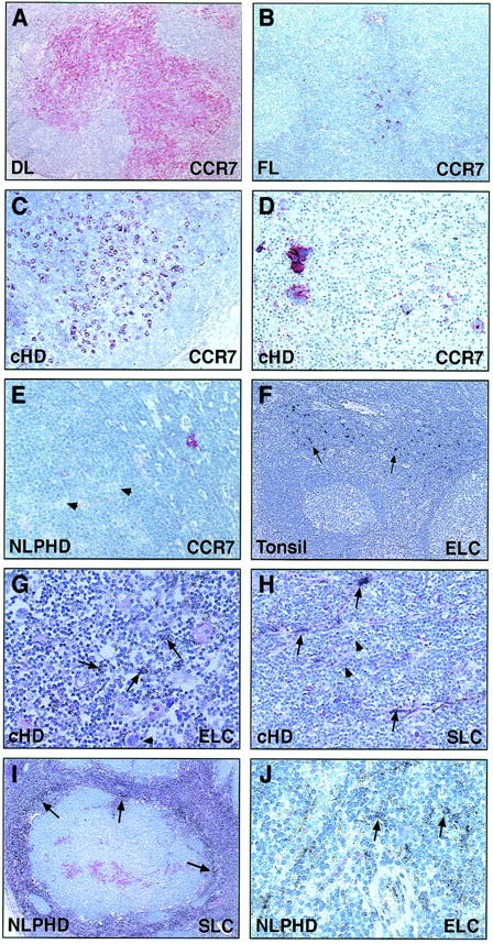 Fig. 6. Immunohistology of CCR7. / Immunohistochemical detection on paraffin-embedded sections using the 3D12/CCR7 (A-E) monoclonal antibody. In a case of dermatopathic lymphadenopathy, the dendritic cells in the interfollicular zone are strongly positive, whereas the follicles remain unlabeled (A). In a case of follicular lymphoma, CCR7 expression is restricted to dendritic cells, whereas the neoplastic cells are negative (B). The neoplastic cells of 2 cases of cHD are strongly positive for CCR7 (C,D). In contrast, the neoplastic cells in NLPHD (arrowheads) are negative, whereas a single cell (probably a dendritic cell) is stained (E). (F-J) Radioactive in situ hybridization with a probe specific for ELC or SLC transcripts. In a hyperplastic tonsil, ELC is observed only in the interfollicular zone (F). In cHD, reactive cells within the tumor infiltrate express ELC (G) and SLC (H). The nodules in NLPHD are negative for both chemokines (I,J), but SLC-specific signals (I) are found in the internodular areas and ELC-specific signals are observed outside the nodules (J). All chemokines are expressed in either the nonneoplastic leukocytic infiltrates of HD or stromal cells, but not in the HRS cells (arrows). Original magnification, × 20 (F, I), × 40 (A), × 100 (B, D), × 200 (C, E, G, H, J).