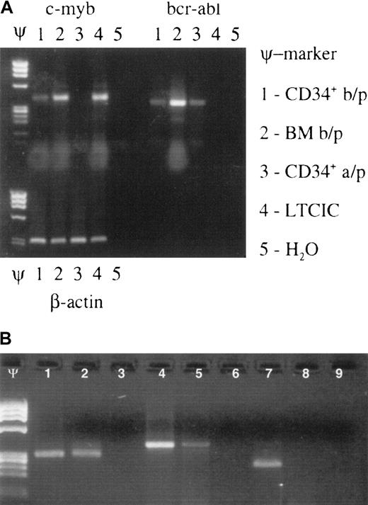 Fig. 1. Effect of Myb ODN purging on brc/abl–expressing primitive hematopoietic stem/progenitor cells. / Myb ODN purging preferentially affects malignant (brc/abl–expressing) primitive hematopoietic stem/progenitor cells. (A) Ethidium bromide–stained agarose gel containing c-myb, bcr-abl, and β-actin mRNA RT-PCR products derived from patient no. 16's CD34+cells before marrow purging (b/p); whole bone marrow cells (BM) before purging; CD34+ cells after purging (a/p); LTCICs; and water (H2O) after exposure to the c-myb–targeted ODN for 72 hours. Lanes containing molecular weight markers are indicated by the symbol Ψ. (B) Ethidium bromide–stained agarose gel demonstrating β-actin (lanes 1-3), c-myb (lanes 4-6), and bcr/abl mRNA (lanes 7-9) expression in CFU-GM colonies derived from a single patient's untreated (lanes 1, 4, 7) or anti-Myb ODN–purged (lanes 2, 5, 8) LTCICs. Respective H2O control reactions are shown in lanes 3, 6, and 9. Molecular weight markers: Ψ.