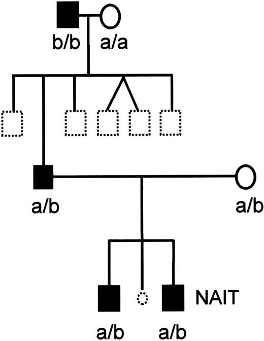 Fig. 1. Pedigree of the family Oe. / Black symbols represent Oea (+) and open symbols Oea (−) individuals. Dotted symbols represent individuals who were not typed. The child with NAIT is indicated. The HPA-1a and HPA-1b phenotypes are shown. Oe and HPA-1 alleles of the affected child and his brother were identified by genotyping.
