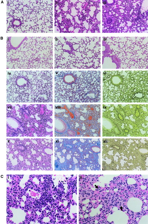 Fig. 2. Pulmonary histology of IL-18/IL-2–treated mice. / (A) Acute lethal effect. B6 mice were daily administered PBS alone (Ai) or a high dose of IL-18 (1 μg) plus 50 000 IU IL-2 (Aii-Aiii). Necropsy was performed after 2 (Aii) and 4 (Ai,Aiii) days of the treatment, and the lung tissue was microscopically observed with HE staining. Original magnification at the observation at × 200. (B) Chronic effect. B6 mice were daily administered a low dose of IL-18 (0.1 μg) plus 50 000 IU IL-2 (Biv-Bxii), PBS alone (Bi), IL-2 (50 000 IU) alone (Bii), or IL-18 (0.1 μg) alone (Biii), and were killed at the time point indicated (day 8, Biv-Bvi; day 18, Bvii-Bix; day 30, Bi-Biii; day 36, Bx-Bxii). The lung tissue was microscopically observed with HE (Bi-Biv,Bviii,Bx), Azan (Bv,Bviii,Bxi), or EVG (Bvi,Bix,Bxii) staining. Original magnification at the observation at × 200. (C) Morphology of the infiltrating cells. B6 mice were daily administered a high dose of IL-18 (1 μg) (Ci) or a low dose of IL-18 (0.1 μg) (Cii) plus 50 000 IU IL-2 for 4 and 36 days, respectively. The lung tissue was observed with HE staining. Foam cells (arrows) are present in the thick alveolar walls and general interstitium. Original magnification at the observation at × 400.