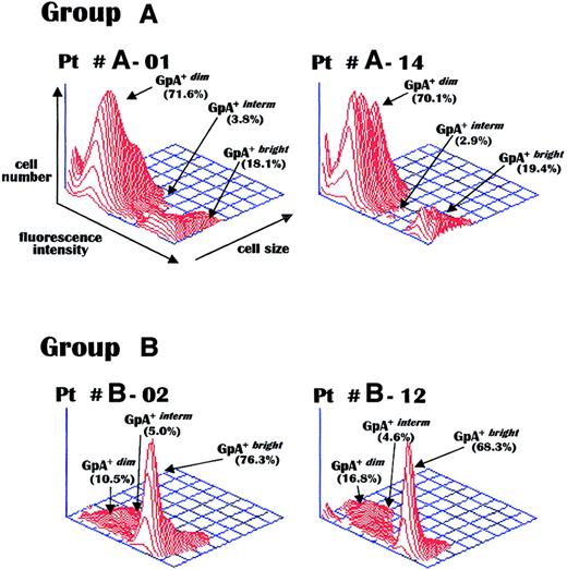 Fig. 1. GpA measurement in erythroblasts. / Representative flow cytometry of GpA expression levels measured via a PE-conjugated antiserum in bone marrow erythroblasts purified from marrows of MM patients with active disease and severe anemia (group A) or with preserved erythropoiesis (group B). Group A patients display a preponderance of immature (GpA+dim) erythroblasts, with a lack of mature (GpA+bright) erythroblasts, as compared to the considerable peak of mature cells in both group B patients. Pt indicates patient.