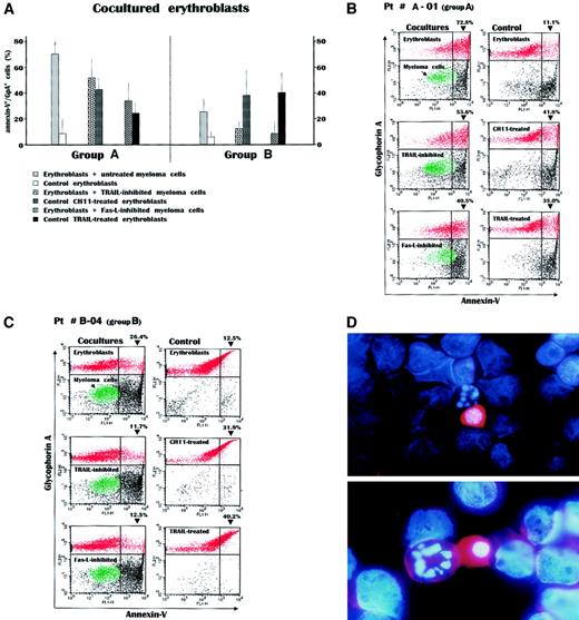 Fig. 3. Measurement of apoptosis by annexin-V detection in erythroblasts after their overnight incubation with autologous myeloma cells. / (A) The experiment included 8 cocultures from group A patients and 7 from group B patients. A great increase in the annexin-V+/GpA+ cell population was recorded within the cocultures from the group A patients. This was particularly evident in cocultures incubating erythroblasts with untreated myeloma cells, whereas the selective disablement of either Fas-L or TRAIL in parallel cultures whose myeloma cells were inhibited by the soluble Fas-Fc or the anti-TRAIL antibody, respectively, revealed the effect separately induced by each apoptogenic receptor of myeloma cells. These effects were almost equivalent to those obtained in control erythroblasts directly stimulated by either the CH11 anti-Fas mAb or the recombinant TRAIL. On the contrary, the effect induced in the cocultures from group B patients by the autologous plasma cells was modest and lower than the respective values observed in group A patients (P < .02 in all instances). Values are mean ± SD of double-fluorescent (annexin-V+/GpA+) cells. (B) Flow cytometry analysis of cocultured cells from a patient with severe anemia. Incubation of erythroblasts (red) with myeloma cells (green) induced a dramatic increase of annexin-V+cells within the GpA+ population. This effect, presumably induced by the concurrent expression of both Fas-L and TRAIL by myeloma cells (top), was then separately measured by inhibiting either TRAIL (middle) or Fas-L (bottom) and was still higher than that recorded in control erythroblasts treated with the anti-Fas mAb or TRAIL (right). (C) Erythroblasts from a patient with preserved erythropoiesis were only moderately driven to apoptosis by their autologous plasma cells and the alternate inhibitions abolished the feeble cytotoxic effect in both cases. (D) Morphologic pattern in the coculture from patient A-1. The malignant myeloma cells among the erythroblasts whose nuclei are stained in blue by DAPI show a high content of TRAIL (red) detected by the PE-conjugated antibody in both cytoplasm and membrane and are adjacent to apoptotic erythroblasts characterized by nuclear fragmentation. Original magnification, × 50 (top), × 100 (bottom).