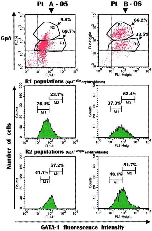Fig. 5. GATA-1 measurement in fresh erythroblasts. / The transcription factor was detected in myeloma patients with severe (A-05) or without (B-08) anemia showing a discrepancy in their extent of GpA+dim (R1) and GpA+bright (R2) populations. The immature erythroblast subset expressing GATA-1 at very low intensity (M1) was considerably expanded in the anemic patient (76.1% versus 37.3% of patient B-08) to the detriment of the M2 population, which included immature erythropoietic cells with a regular to high content of GATA-1. Conversely, the M2 population was substantial (62.4%) in patient B-08. GATA-1 at either low or high fluorescence intensity was similarly expressed as percentage of positive cells in both patients, though the proportion of the mature erythroblast population was modest in the anemic patient.