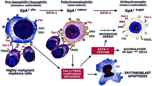 Fig. 6. Defective erythropoiesis in MM. / Hypothetical model of the pathogenic defective maturation of erythroid cells by malignant cytotoxic plasma cells in active MM. GpA+dim erythroblasts progress to the GpA+bright form by GATA-1. At their prebasophilic/basophilic stage (GpA+dim), erythroblasts are highly susceptible to Fas stimulation because they can be negatively regulated by Fas-L from mature (GpA+bright) erythroblasts just as GpA+interm erythroblasts are restrained by TRAIL. Fas and the TRAIL receptors, namely, DR4/DR5 molecules, are expressed during erythroid differentiation, though they are not functional in specific stages (empty symbols). Highly malignant myeloma cells express large amounts of both Fas-L and TRAIL and exert a direct erythroblast cytotoxicity by inducing apoptosis. The cytotoxic mechanism operates during either the immature or the semimature stage of differentiation by both Fas and DR4/DR5. The cytoplasmic caspases activated by these apoptogen receptors induce the cleavage of GATA-1, whose intracellular defect promotes an arrest in the maturative progression. This results in a relative increase of immature erythroblasts and systematic impairment of the erythroid matrix.