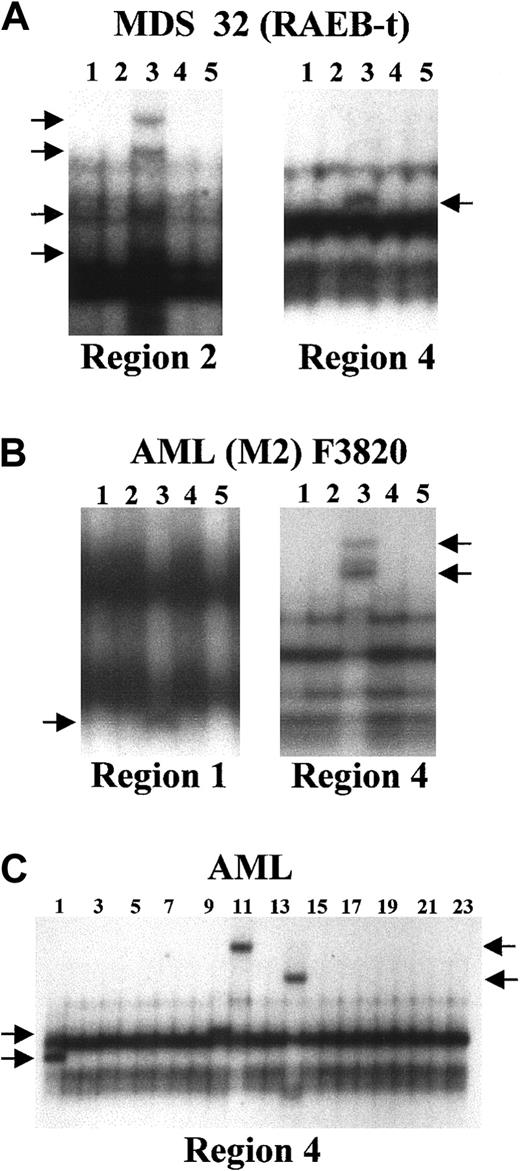 Fig. 2. PCR-SSCP analysis of the C/EBPα gene locus. / (A) Abnormally migrating bands in lane 3 of both panels for the MDS (RAEB-t) patient F3881. Region 2 is a 37-bp duplication and region 4 is a 1015G>T. The other lanes are derived from genomic DNA samples of other MDS patients and display bands with normal mobility. (B) Abnormally migrating bands in lane 3 of both panels for the AML-M2 patient F3820. Region 1 is a 1-bp deletion of C381, and region 4 is a 24-bp duplication of nt 1062 through 1085. The other lanes are derived from genomic DNA samples of other AML patients and display bands with normal mobility. (C) Abnormally migrating bands for region 4 are detected in lanes 1 (patient F3901), 10 (patient J2), 11 (patient J3), and 14 (patient J6). Lane 1 is a 3-bp deletion of nt 1083 through 1085; lane 10 is a transversion of 1001C>A; lane 11 is 15-bp duplication of nt 1083 through 1097; and lane 14 is a 3-bp duplication of nt 1083 through 1085. The other lanes are derived from genomic DNA samples of other AML patients and display bands of normal migration. The arrows at the left and right of each panel indicate the positions of the shifted bands.