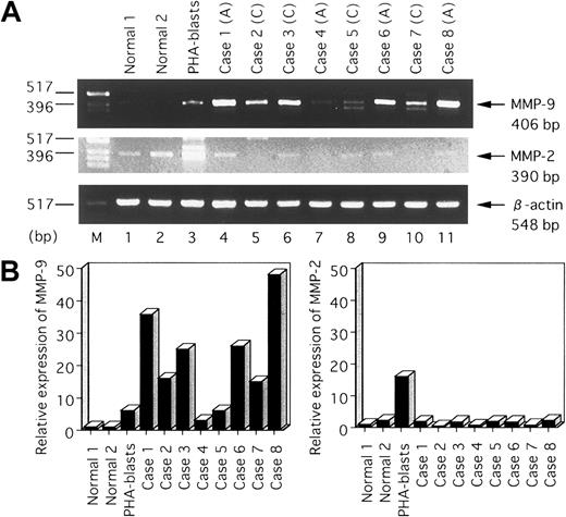 Fig. 8. Detection of MMP-9 mRNA in leukemic cells obtained from patients with ATL by RT-PCR analysis. / (A) Lanes 1 and 2, RNA from normal resting PBMCs; lane 3, RNA from PHA blasts; lanes 4-11, RNA from PBMCs from patients with ATL. (A) indicates acute type; (C), chronic type. Bottom, ethidium bromide–stained gel showing β-actin PCR products. Arrows indicate positions of the specifically amplified DNA. (B) Quantitative hybridization capture assay to detect amplified nucleic acid of MMPs. Results show relative levels of the MMPs/β-actin compared with MMPs/ β-actin in normal 1.