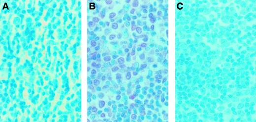 Fig. 9. Immunohistochemical findings of the lymph node biopsy from an ATL case. / The serial sections of lymph node biopsy specimens were stained with control mouse IgG (A) and 56-2A4 mAb (B). (C) To ensure the specificity of 56-2A4 mAb, blocking was done with MMP-9. The tissue sections were stained with 56-2A4 mAb after incubation with MMP-9 (C). Sections were counterstained with methyl green; original magnification × 400. Mononuclear cells infiltrating are clearly positive for MMP-9 (B).