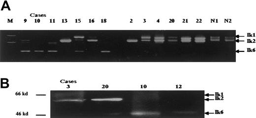 Fig. 1. Pattern of Ikaros proteins expression in AML cases. / (A) In the nested RT-PCR analysis, M indicates the 100-base pair (bp) ladder marker; lanes 1 to 7 represent FAB M4, M5a, and M5b cases; lanes 8 to 10; M2 cases; lanes 11 to 13; M7 cases. N1 and N2 indicate normal controls. The sizes of the RT-PCR products were Ik1, 907 bp; Ik2, 646 bp; and Ik6, 220 bp. (B) In Western blot analysis, the arrows indicate the positions of Ikaros isoforms; molecular mass Ikaros isoform 6 standards are included on the left. Case numbers are the same as in Table 1.