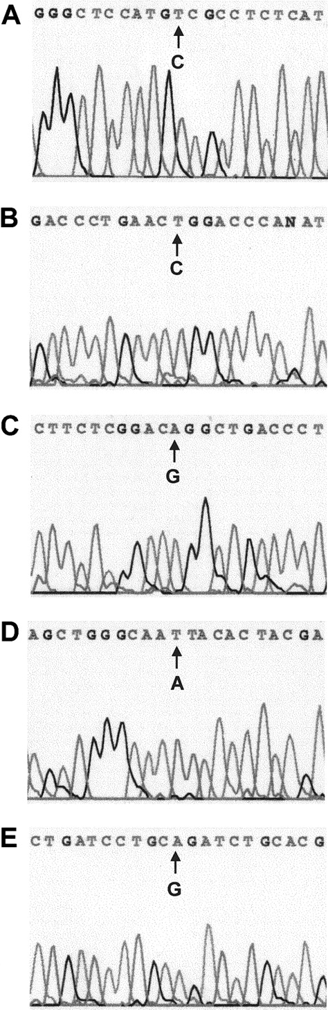 Fig. 1. Automated DNA sequence analysis of nested, PML-RARα allele-specific PCR products from 5 APL cases with single nucleotide changes. / (A) Case 1, C→T (Pro→Ser). (B) Case 4, C→T (Arg→Trp). (C) Case 6, G→A (Gly→Arg). (D) Case 7, A→T, (Lys→Asn). (E) Case 8, G→A (Arg→Gln).