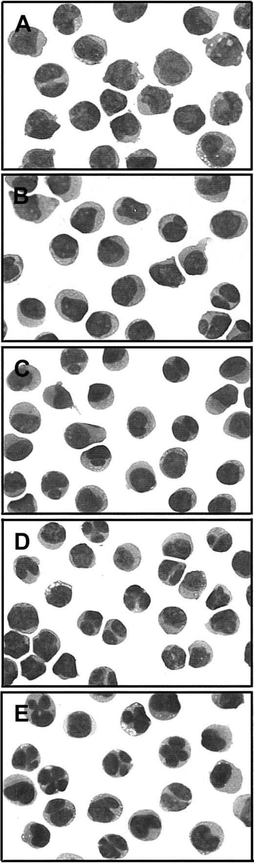 Fig. 5. Cytologic evaluation of APL cells from PML-RARα Gly289Arg mutant case 6 in the absence or presence of RA or NaB alone and in combination. / Photographs of cytospin slide preparations of sodium metrizoate–selected low-density (P ≤ 1.077 g/mL) bone marrow cells were taken at × 1000 magnification of modified Wright stain (Dif-Quik, Sigma, St Louis, MO). (A) Prior to culture; (B-E) cultured × 4 days with (B) no added drug, (C) 1 μM RA, (D) 1 mM NaB, or (E) 1 μM RA + 1 mM NaB.
