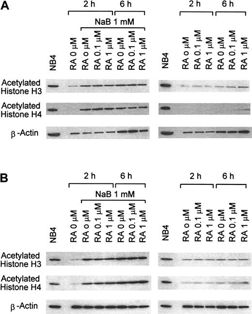 Fig. 7. Western blot analysis of H3 and H4 histone acetylation in APL cells. / APL cells from case 6 (A) and AP-1060 cells (B) were treated with 1 mM NaB, 1 μM RA, or 1 mM NaB + 1 μM RA for the indicated periods of time in tissue culture.