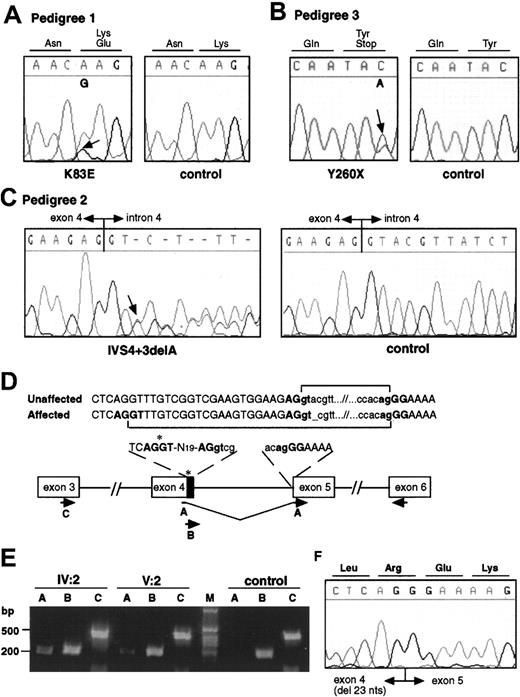 Fig. 2. Mutation analysis in FPD/AML pedigrees. / Electropherograms from affected and control individuals showing the A>G substitution leading to the K83E missense mutation in pedigree 1 (A), the C>A substitution resulting in a nonsense mutation Y260X in pedigree 3 (B), and the deletion of an A at the +3 position of the splice donor site of intron 4 in pedigree 2 (IVS4 + 3delA, C). Arrows indicate the point of the mutations. (D) Schematic representation of the cryptic splice site within exon 4 used in the mutated transcript in pedigree 2 and the RT-PCRs used to analyze the splicing. A, B, and C represent forward primers used in the RT-PCR experiment. Primer A is specific to the mutated form, and primer B is specific to the wild-type form. Primer C was used as control. The same reverse primer was used in each reaction. The 23 nucleotides of exon 4 excluded from the mutant transcript are indicated by the black box. (E) RT-PCR on patient and control RNA as described in panel D. The primer specific to the mutated form does not show any amplification on control RNA. (F) Sequence analysis of the mutant exon 4–exon 5 junction.