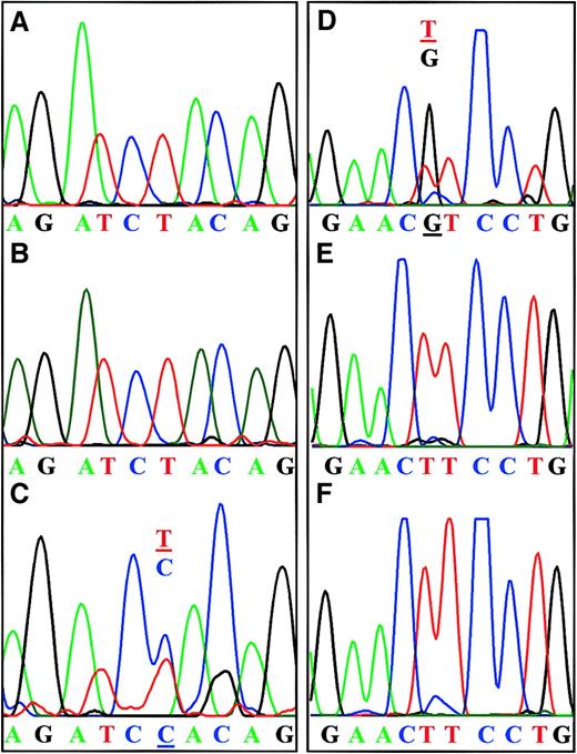 Fig. 1. BCL10 mutations in MALT-type lymphomas. / (A-C) Direct sequencing results from case 25. (A) Normal DNA derived from whole tissue sections. (B) Normal DNA derived from a small tumor cell cluster obtained by microdissection. (C) Substitution at position 620: T > C in DNA derived from large tumor cell cluster. Residual peak of T indicates the presence of normal alleles. (D-F) Direct sequencing results from case 14. (D) Substitution at position 280: T > G in DNA derived from whole tissue sections. Residual peak of T indicates the presence of normal alleles. (E) Normal DNA in normal cells. (F) Normal DNA in a cell cluster microdissected from the tumor.