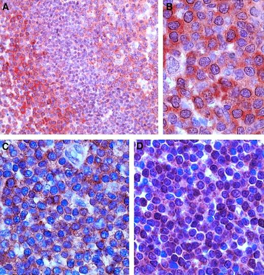 Fig. 2. Immunohistochemical staining for BCL10 protein expression. / (A) Reactive spleen with strong cytoplasmic BCL10 expression in the marginal zone and in the germinal center and absent to weak expression in the lymphocytic corona. Original magnification × 400. (B) High magnification of splenic reactive marginal zone cells, expressing BCL10 in the cytoplasm and not in the nucleus. Original magnification × 1000. (C) Cytoplasmic BCL10 expression in the tumor cells of case 20 (MALT-type lymphoma without the API2-MLT fusion). Original magnification × 1000. (D) Aberrant nuclear BCL10 expression in case 4 (MALT-type lymphoma with the API2-MLT fusion). Original magnification × 1000.