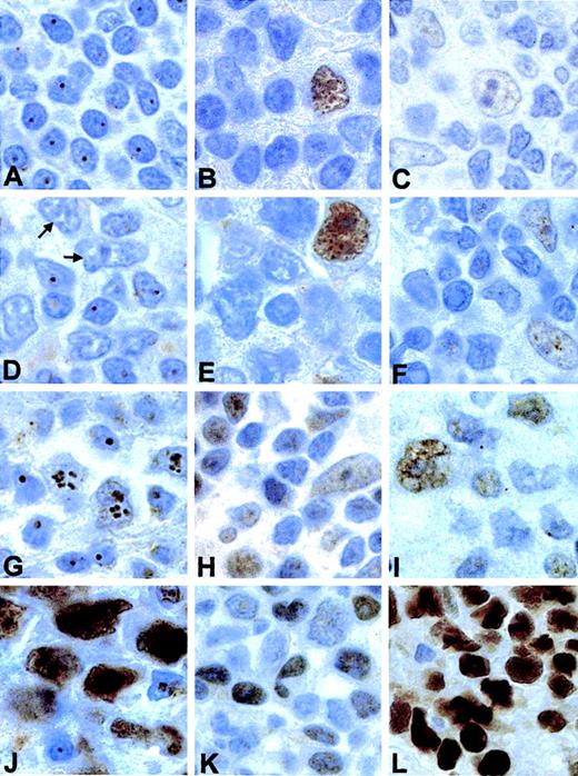 Fig. 2. Immunohistochemical study of p14ARF, Hdm2, and p53 in normal and tumoral lymphoid tissue. / (A) Distinct nucleolar p14ARF staining, in nontumoral lymphoid tissue (a reactive lymphadenitis). (B) Hdm2 and (C) p53 in the same sample. (D) An NHL case with loss of p14ARF in tumoral cells (indicated by arrows); normal lymphocytes retain nucleolar p14ARF expression. Hdm2 (E) and p53 (F) in this case are also shown. (G) An NHL case showing nucleolar p14ARF in tumoral cells, with intermediate Hdm2 (H) and p53 (I) expression. (J) Nuclear p14ARF overexpression (note the nucleoli in small lymphocytes) associated with high levels of Hdm2 (K) and p53 overexpression (L). Original magnification × 1000.