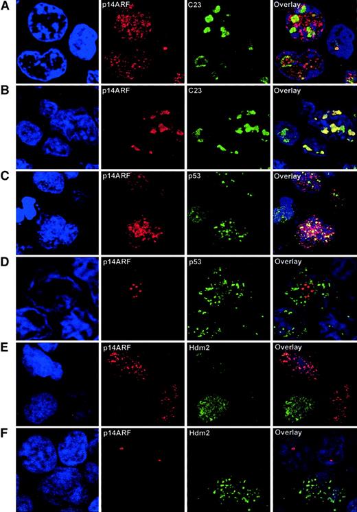 Fig. 3. Confocal microscopy analysis of NHL samples. / (A) Double immunolabeling for p14ARF and the nucleolar marker C23 in a sample with p14ARF nuclear overexpression, showing that a significant fraction of the p14ARF signal is extranucleolar. Note the nucleolar p14ARF signal in the normal lymphocyte (right). (B) A sample with intense nucleolar accumulation of p14ARF, coincident with the C23 signal, is shown for comparison. (C) Double immunolabeling for p14ARFand p53 shows a partial colocalization of nucleoplasmic p14ARF and p53. (D) Lack of colocalization in a sample with nucleolar p14ARF, where the discrete granular p14ARF signal contrasts with the nucleoplasmic distribution of p53. (E) Lack of colocalization between nucleoplasmic p14ARF and Hdm2. (F) Hdm2 expression in a tumoral cell where p14ARF is absent; however, nucleolar p14ARF is expressed in adjacent lymphocytes lacking detectable Hdm2. Original magnification × 2000-3500.
