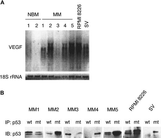 Fig. 2. MM cells express VEGF mRNA. / (A) Total RNA (5 μg) from control NBM1-2, patient MM1-5, RPMI 8226, and SV MM cell lines was size separated on a 1.4% agarose-formaldehyde gel, blotted, and probed with a 32P-labeled VEGF cDNA probe that recognizes VEGF transcripts of approximately 3.7 to 4.4 kb. A32P end-labeled oligonucleotide probe for 18S rRNA was used as the loading control. (B) Patient MM1-5 cells and 2 MM cell lines were lysed, immunoprecipitated with wt p53 and mutant (mt) p53 mAbs, and subjected to immunoblotting with an anti-p53-HRP mAb.