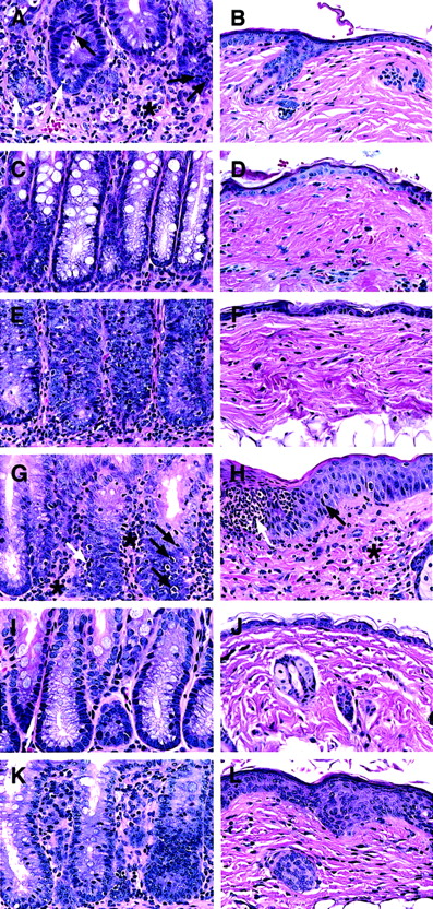 Fig. 3. Ability of CD4+ and CD8+ T-cell subsets from PB and BM to induce histopathologic lesions of GVH disease in the colon and skin. / Sections are stained with hematoxylin and eosin and the original magnification is × 400. Each panel is representative of 4 recipients. (A,B) Intestine and skin of a BALB/c recipient with severe clinical GVH disease injected 50 days earlier with TCD BM and sorted PB CD4+ T cells. There is an expanded lamina propria with marked lymphocytic infiltration (asterisk) and infiltration into the glandular epithelium (black arrow). There are apoptotic bodies in the glandular epithelium also (white arrow). The skin appears to be normal. (C,D) The colon and skin sections of a healthy recipient injected 45 days earlier with TCD BM and BM CD4+ T cells. Plump mucin-containing glandular cells are seen lining the crypts with little or no inflammation. The skin appears to be normal. (E,F) The tissue sections of a recipient with slight diarrhea injected 45 days earlier with BM NK1.1− CD4+ T cells. The colon shows lesions of GVH disease, but the skin appears to be normal. (G,H) The sections of a recipient with severe clinical GVH disease injected 50 days earlier with TCD BM and PB CD8+ T cells. The colon shows lesions of GVH disease with lymphocytic infiltration of the lamina propria (asterisk) and crypts (black arrows) and apoptotic crypt cells (white arrow). The skin shows hyperplasia (black arrow) and microabscesses (white arrow) in the epidermis and lymphocyte infiltration in the dermis (asterisk). (I,J) The sections of a healthy recipient injected 45 days earlier with TCD BM and BM CD8+T cells. No abnormalities are seen. (K,L) The sections of a recipient with slight diarrhea and hair loss injected 45 days earlier with TCD BM and BM NK1.1− CD8+ T cells. There are lesions of GVH disease in both tissues, including inflammation of intestine crypts, epidermal hyperplasia, and dermal infiltration.