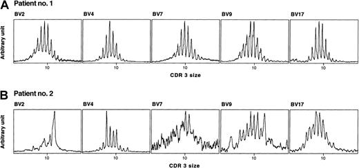 Fig. 1. Representative examples of TCRBV CDR3 size distribution in 2 age-matched HSC recipients. / cDNA was amplified in PCR reactions primed by one BV subfamily and a BC-specific fluorescent primer. Patient no. 1 (age at transplantation, 17.7 years) was studied at 26 months after CBT, without episode of GVHD, had totally polyclonal BV families and a high TREC value (11 614/μg CD3+ DNA). Patient no. 2 (age at transplantation, 16.5 years), studied at 24 months after BMT, after an episode of acute GVHD, had several TCRBV disturbances (BV2, BV4, and BV9), an undetectable family (BV7), and a low TREC value (389/μg CD3+ DNA). Both patients were treated for acute lymphoblastic leukemia.
