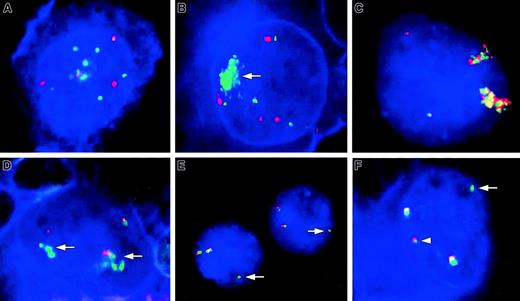 Fig. 1. Involvement of theREL and BCL11A loci in cHL detected by FISH and FICTION. / (A,B) FICTION analyses using probes for REL (green signals) and CEP2 (red signals) showing multiple copies of REL in cHL11 (A) and a high-level amplification of REL (arrow) in cHL1 (B). The tumor cells of both cases contain 4 copies of CEP2. (C-F) FISH (C,E) and FICTION (D,F) analyses with probes for REL(green signals) and BCL11A (red signals) loci. (C) FISH in case cHL45 with del(2)(p14p23) and add(2)(p?)x2 identified a massive copy gain of both REL and BCL11A loci in HRS nuclei most likely due to 2 chromosomes containing a 2p amplicon. Two colocalized signals for each probe indicate 2 additional intactREL/BCL11A loci. (D) Amplification of the RELlocus (arrows) without coamplification of BCL11A locus in cHL8. (E,F) Signal patterns indicating a translocation breakpoint within the region spanned by the REL probe or, less likely, between the REL and BCL11A loci. (E) FISH in case cHL46 with t(2;22)(p16;q12) and der(9)t(2;9)(p16;p22) revealed 2 colocalized signals for the REL and BCL11A loci and an additional isolated signal for the REL locus (arrow). (F) FICTION in cHL17 showing 2 intact BCL11A/REL fusions and one split of the REL probe, displayed as one isolated green (arrow) and one red/tiny green fusion signal (arrowhead).