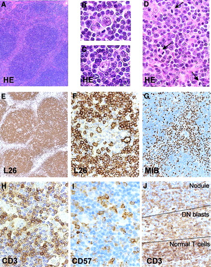 Fig. 1. Histology and immunohistochemistry of the lymph node. / Nodular architecture (A), presence of L&H RS cells in the nodules (B,C), internodular proliferation of blasts (D; mitotic figures are indicated with an arrow), predominance of CD20+ small B cells (E), presence of CD20+ L&H cells (F), Mib-1 positivity of the internodular blasts (G), presence of many CD3+ and a smaller number of CD57+ T cells surrounding the L&H cells (H,I), and presence of relatively weakly positive CD3 blasts between the nodules and the band of stronger staining CD3+ small T cells (J). Original magnifications × 28 (A,E), × 900 (B,C), × 500 (D,F,H.I), × 87 (G), and × 350 (J).