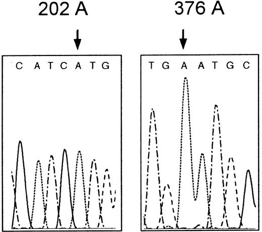 Fig. 1. Partial nucleotide sequence of G6PD Asahi. / The proband's G6PD gene has the mutation 202G>A (left) but not the 376A>G (right).