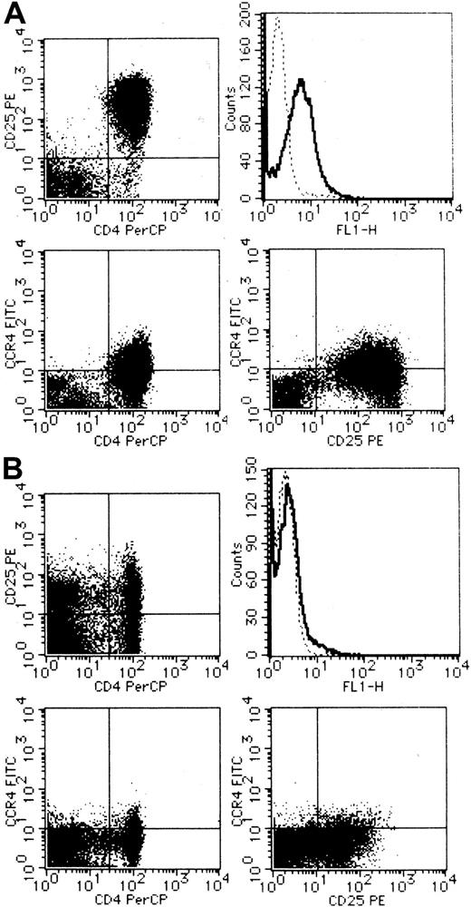 Fig. 3. Flow cytometric analysis on surface expression of CCR4. / PBMCs were obtained from a patient with ATL (A) and a healthy adult (B). CCR4 was stained singly (upper right) or in combination with CD25 (lower right) or CD4 (lower left). Double staining for CD4 and CD25 was also carried out (upper left). See “Materials and methods” for details.