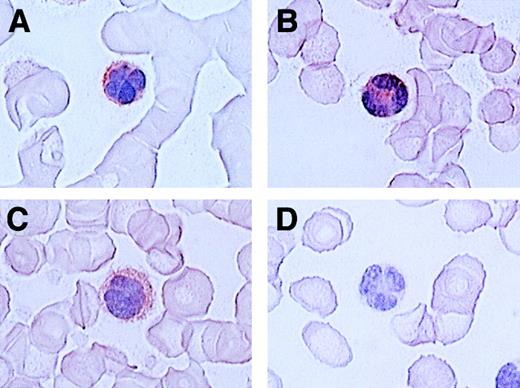 Fig. 4. Immunocytologic staining of CCR4 in blood smears. / Routine blood smears obtained from 4 patients with ATL (A-D) were stained for CCR4 as described in “Materials and methods.” Leukemic cells are positive (A, B, C) or negative (D) for CCR4. No staining was seen by an isotype-matched control mouse IgG (not shown).The slides were counterstained by hematoxylin and the original magnification was × 1000.