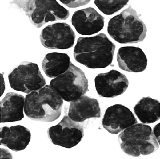 Fig. 6. Giemsa staining of cells migrated to MDC/CCL22. / PBMCs were obtained from a patient with ATL. Cells migrated to MDC in chemotaxis chambers were collected and stained with Giemsa as described in “Materials and methods.” Original magnification, × 1000.