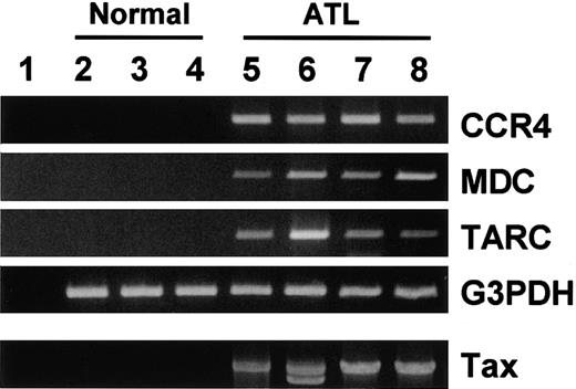 Fig. 7. RT-PCR analysis for CCR4 and its ligands TARC/CCL17 and MDC/CCL22 in normal and ATL skin tissues. / Total RNA and DNA were prepared from normal skin tissues from 3 adult donors (2, 3, 4) and lesional skin tissues from 4 patients with ATL (5, 6, 7, 8). RT-PCR was carried out for CCR4, MDC, TARC, and G3PDH as described in “Materials and methods.” Genomic PCR was carried out for tax as described in “Materials and methods.” (1) No RNA. (2-4) Normal skin tissues. (5-8) Lesional skin tissues from patients with ATL.