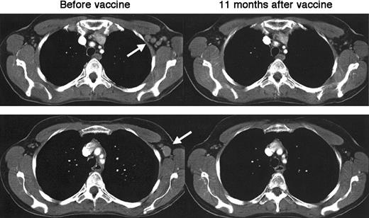Fig. 1. Complete regression of lymphoma after idiotype-pulsed dendritic cell vaccination. / CT images of the chest of patient D9 show multiple enlarged left axillary lymph nodes that normalized 11 months after vaccination. Arrows indicate sites of disease before vaccination. Similarly sized lymph nodes in the periaortic and iliac regions also completely regressed.