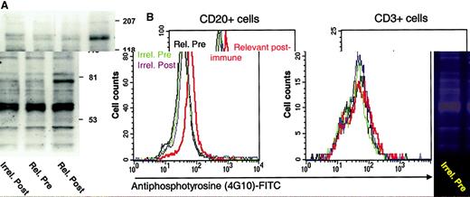 Fig. 4. Idiotype-immune serum induces tyrosine phosphorylation specifically in tumor B cells. / (A) Detection of tyrosine phosphorylation in tumor cells by Western blotting. Tumor cells from patient D31 were incubated with the indicated sera and then lysed. Solubilized proteins were separated by SDS-PAGE and transferred to nitrocellulose. The blot was stained with antiphosphotyrosine antibody 4G10. (B) Detection of tyrosine phosphorylation in tumor cells by flow cytometry. Tumor cells from patient D31 were treated with the indicated sera, permeabilized, and stained with antibody 4G10 coupled to FITC. Phosphotyrosine content was then quantitated in aliquots of cells counterstained with either phycoerythrin-labeled anti-CD20 or anti-CD3.