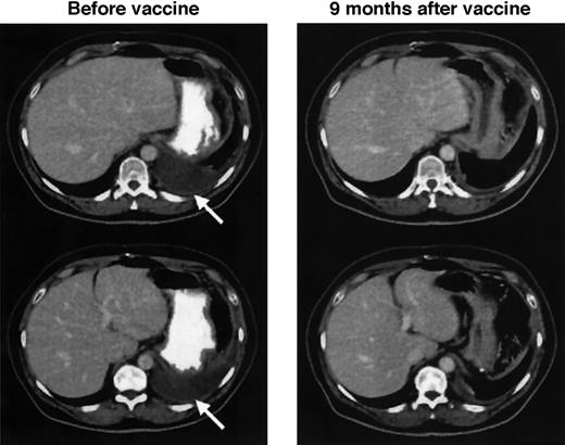 Fig. 5. Regression of lymphomatous pleural effusion after vaccination with Id-KLH–pulsed dendritic cells. / Despite chemotherapy, a left-sided pleural effusion persisted in patient D29 and remained cytologically positive before vaccination. Near-complete resolution is noted 9 months after completing vaccination with Id-KLH–pulsed dendritic cells.